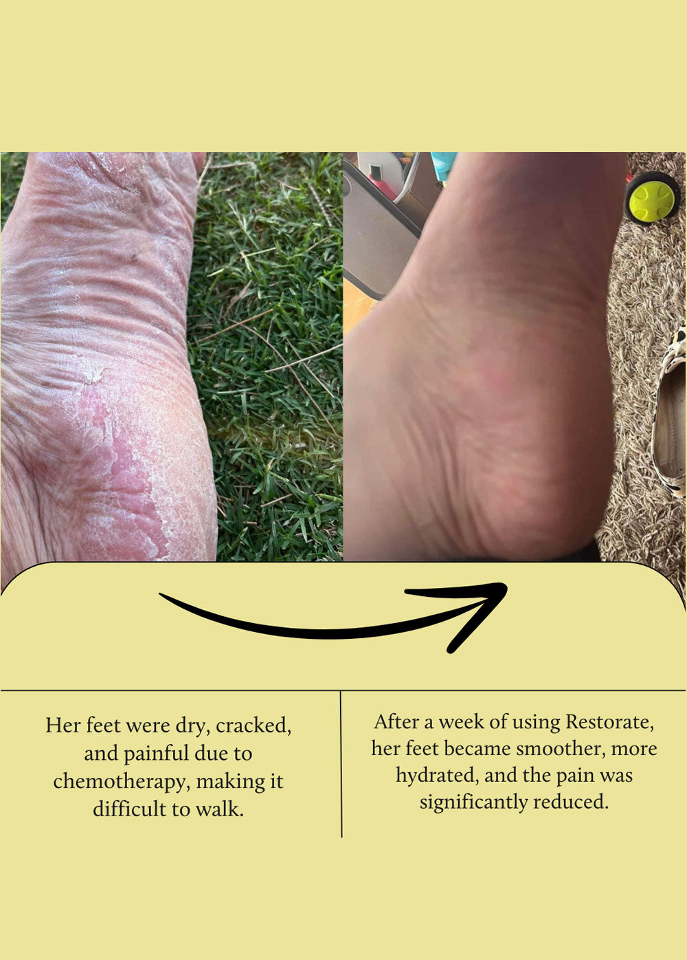 foot and heel balm before and after